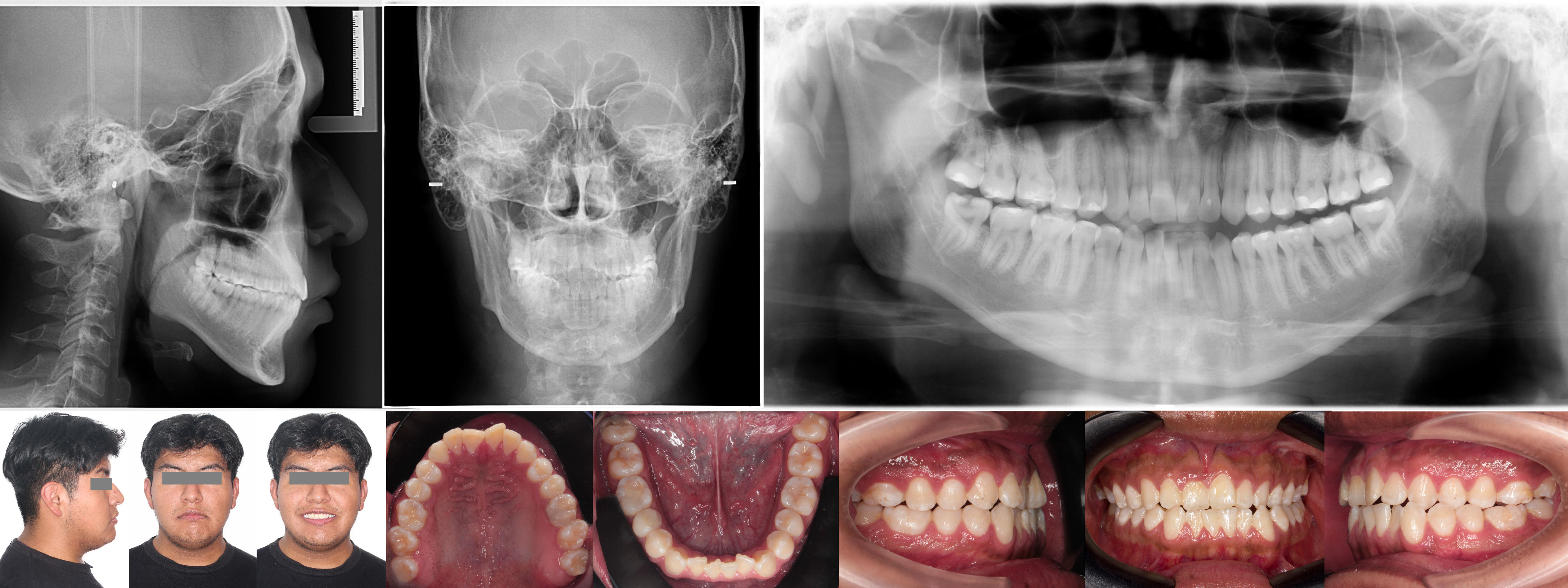 Radiografía Intrabucal